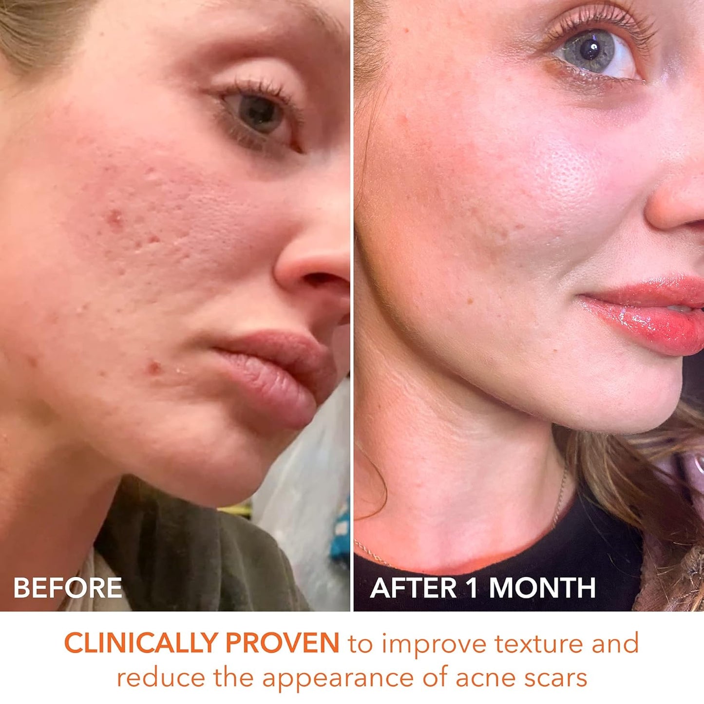 Dr. Dennis Gross Alpha Beta Extra Strength Daily Peel 3pzas - Tratamientos para Peeling